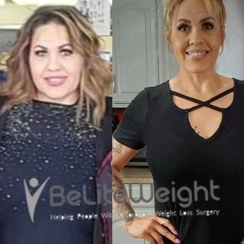 Weight Loss Surgery Gastric Sleeve before and after